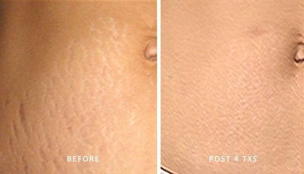 Laser Therapy